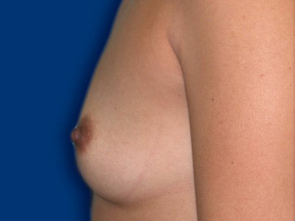 breast augmentation 600 - Patient 15