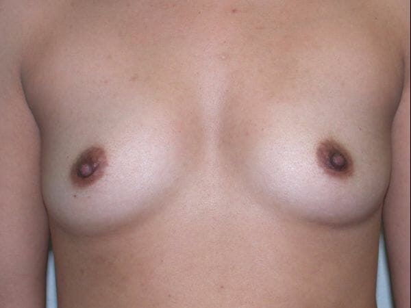 breast augmentation 602 - Patient 15