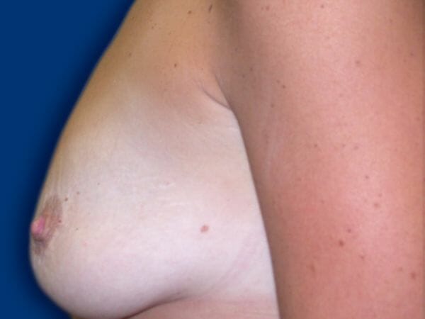 breast augmentation 611 - Patient 18