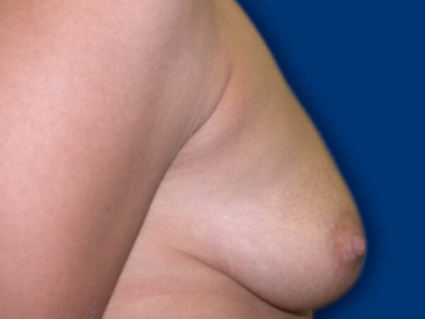 breast augmentation 616 - Patient 20