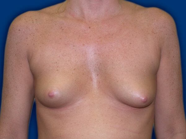 breast augmentation 618 - Patient 20