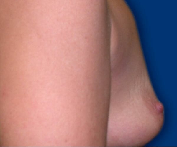 breast augmentation 621 - Patient 21