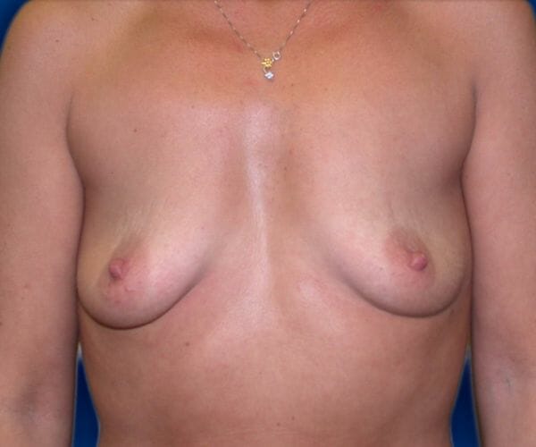 breast augmentation 623 - Patient 21