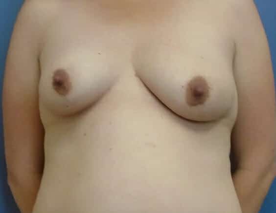 breast augmentation with lift 1808 - Patient 5
