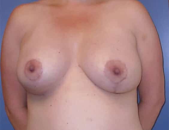 breast augmentation with lift 1809 - Patient 5