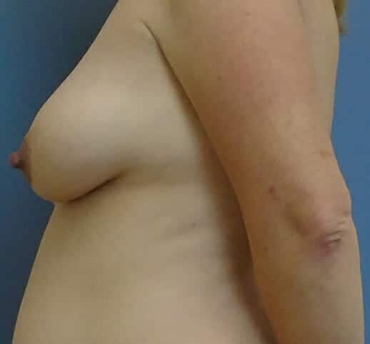 breast augmentation with lift 1810 - Patient 5