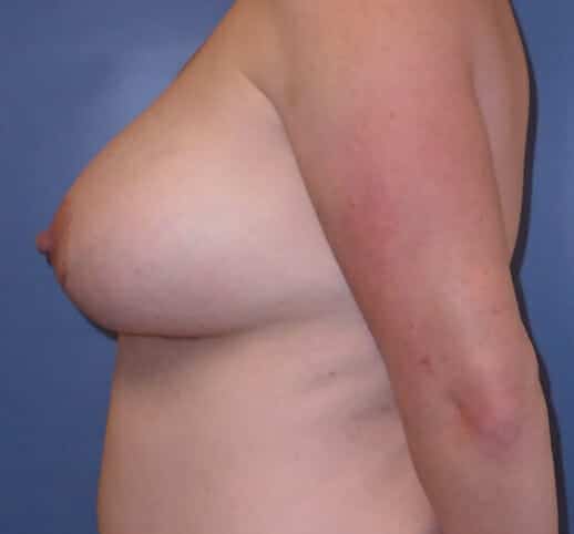 breast augmentation with lift 1811 - Patient 5