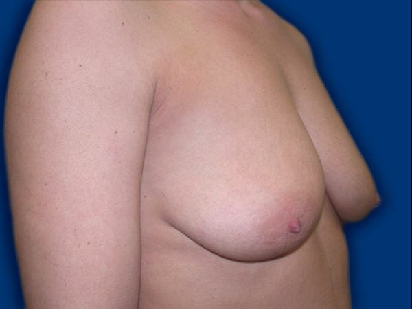 breast augmentation with lift 639 - Patient 3