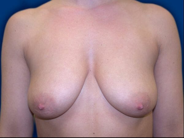 breast augmentation with lift 641 - Patient 3
