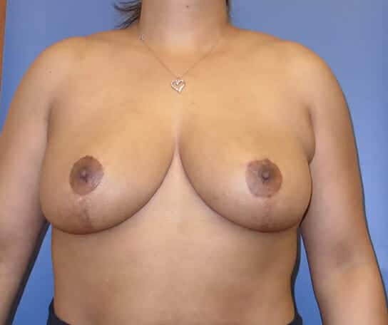 breast lift 1272 - Patient 12