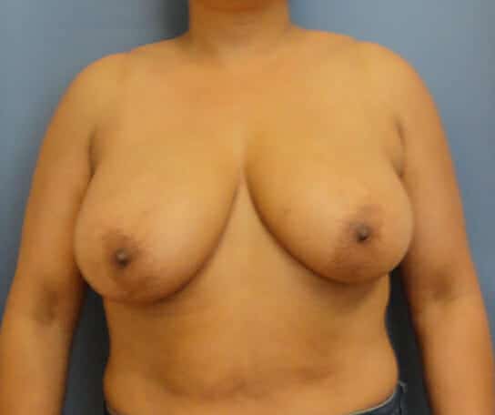 breast lift 1273 - Patient 12