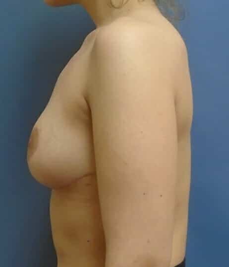 breast lift 1595 - Patient 13