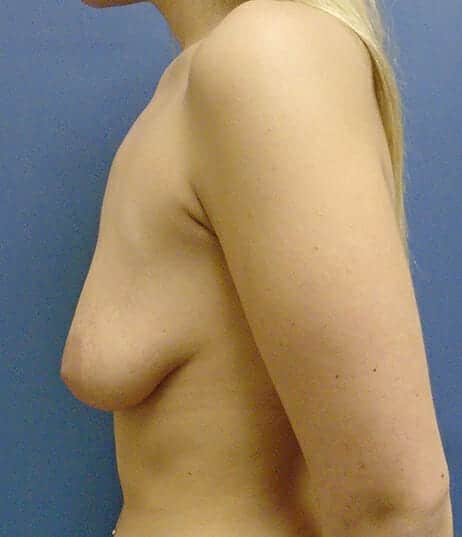 breast lift 1596 - Patient 13