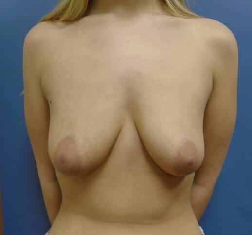 breast lift 1597 - Patient 13