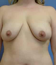 breast lift 2943 - Patient 16