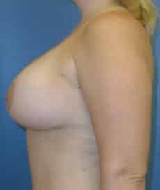 breast lift 2944 - Patient 16
