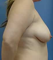 breast lift 2946 - Patient 16