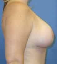breast lift 2947 - Patient 16