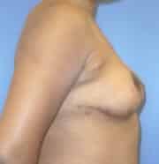 breast lift 3802 - Patient 6