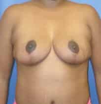 breast lift 3803 - Patient 6