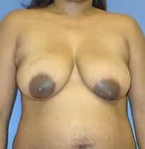 breast lift 3804 - Patient 6