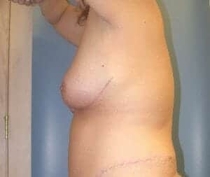 breast lift 4132 - Patient 4