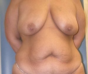 breast lift 4133 - Patient 4