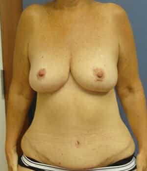 breast lift 5066 - Patient 2