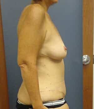 breast lift 5067 - Patient 2