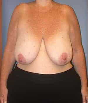 breast lift 5068 - Patient 2