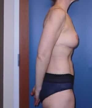 breast lift 5072 - Patient 1