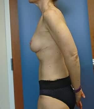 breast lift 5073 - Patient 1