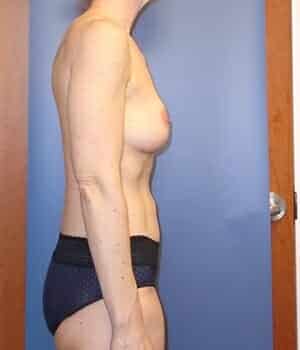 breast lift 5074 - Patient 1