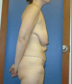 breast lift 5076 - Patient 1