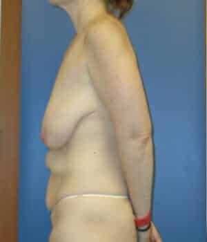 breast lift 5077 - Patient 1