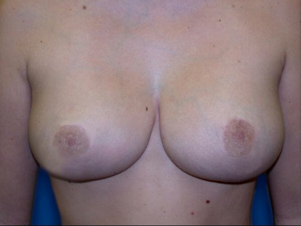 breast lift 646 - Patient 8