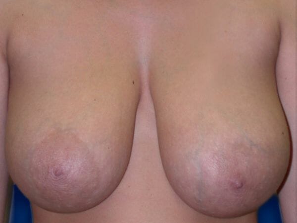 breast lift 647 - Patient 8