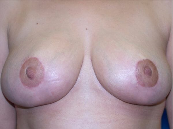 breast lift 649 - Patient 9