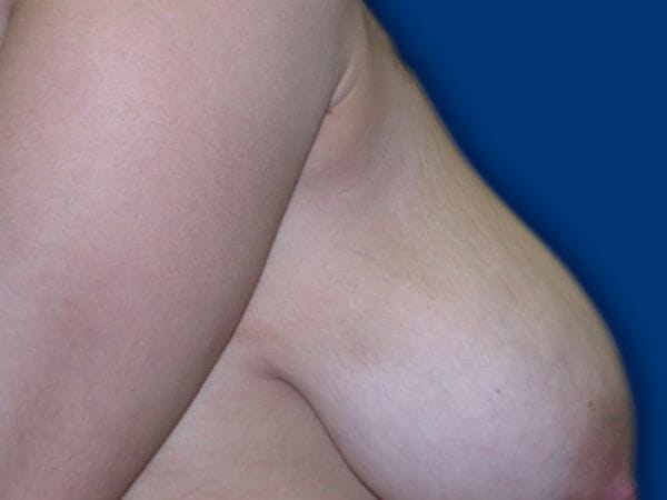 breast lift 650 - Patient 9