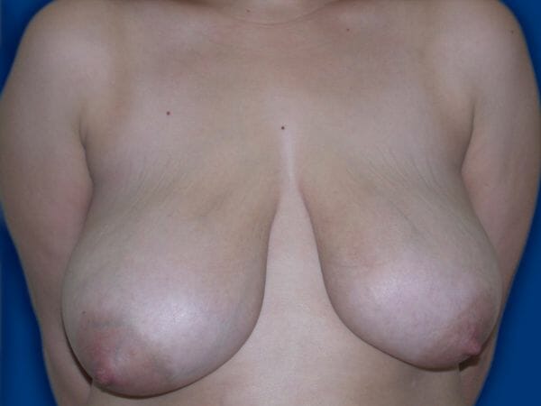 breast lift 652 - Patient 9