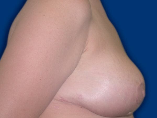 breast lift 656 - Patient 10