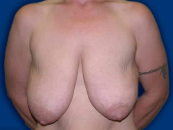 breast lift 657 - Patient 10