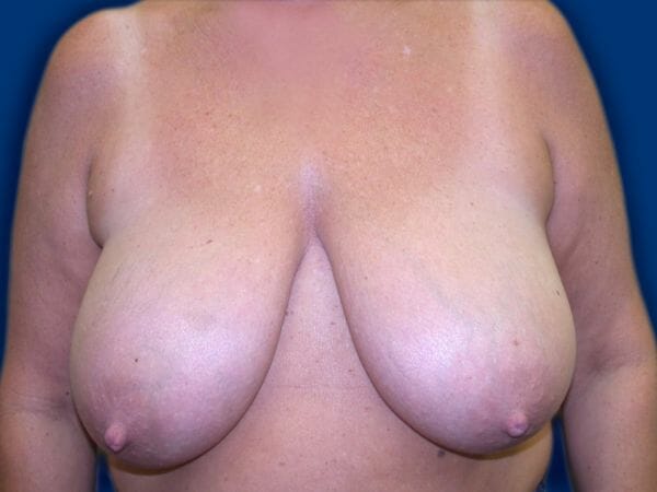 breast lift 660 - Patient 11