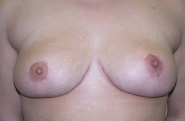 breast reduction 1427 - Patient 16