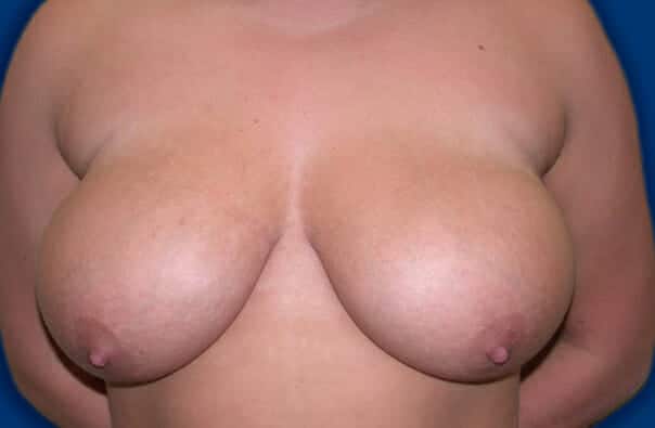 breast reduction 1428 - Patient 16