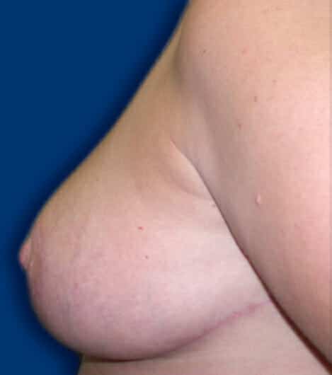 breast reduction 1430 - Patient 17