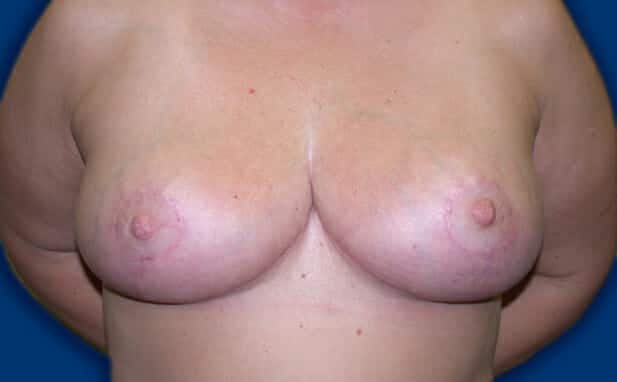 breast reduction 1432 - Patient 17