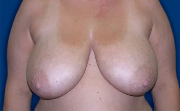 breast reduction 1433 - Patient 17