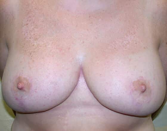 breast reduction 1435 - Patient 18