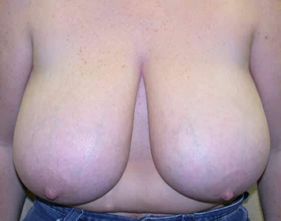 breast reduction 1436 - Patient 18